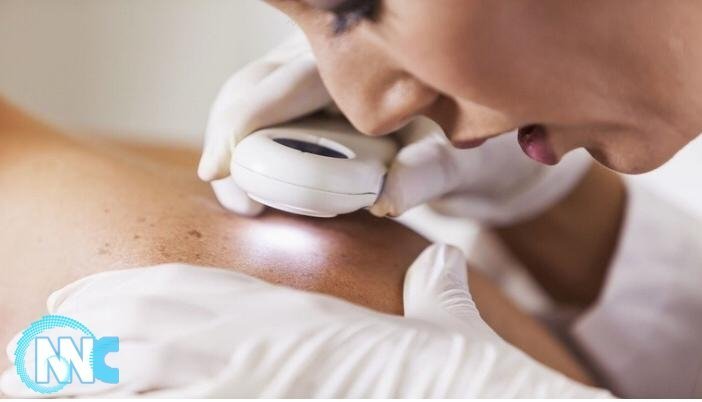 كيف تكشف علامات سرطان الجلد مع تصاعد موجة الحر؟