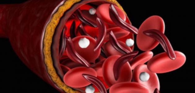 فقر الدم الناجم عن نقص الحديد… الأسباب والأعراض والعلاج